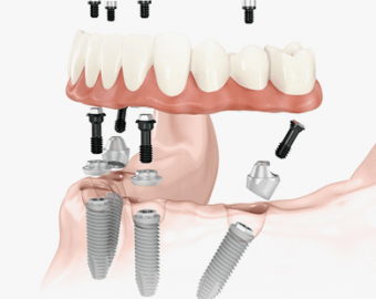 All-on-4 имплантация зубов